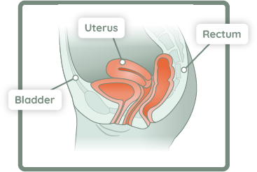 pelvic organ prolapse post-enplace