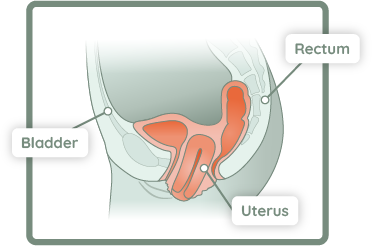 pelvic organ prolapse pre-enplace